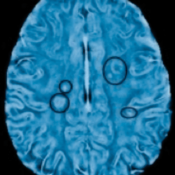 Image: A frequency-based MRI image of an MS patient shows changes in tissue structure (Photo courtesy of the University of British Columbia).